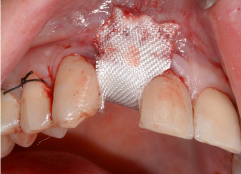 bloodstop, dentingo, bloodstop ix, hämostatikum, matrix, wundheilung, Dental, Dentistry, Zahnarzt, Oralchirurgie, MKG, Extraktion, Sinuslift, Membran, Implantologie, Osteotomie,