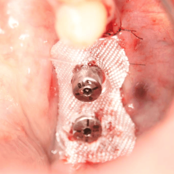 bloodstop, dentingo, bloodstop ix, hämostatikum, matrix, wundheilung, Dental, Dentistry, Zahnarzt, Oralchirurgie, MKG, Extraktion, Sinuslift, Membran, Implantologie, Osteotomie,