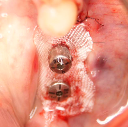 bloodstop, dentingo, bloodstop ix, hämostatikum, matrix, wundheilung, Dental, Dentistry, Zahnarzt, Oralchirurgie, MKG, Extraktion, Sinuslift, Membran, Implantologie, Osteotomie,