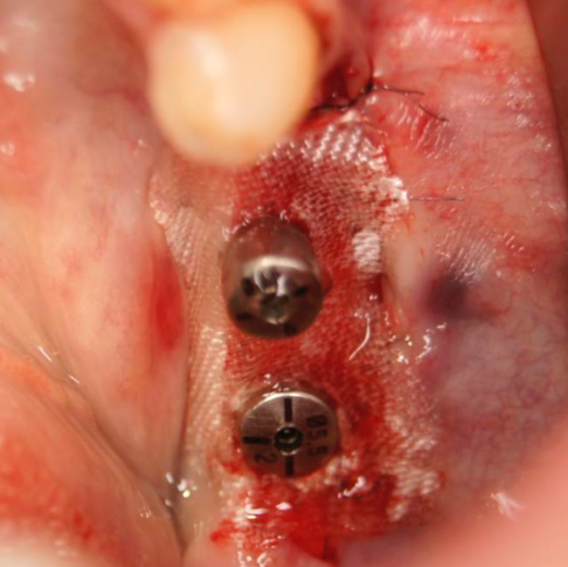 bloodstop, dentingo, bloodstop ix, hämostatikum, matrix, wundheilung, Dental, Dentistry, Zahnarzt, Oralchirurgie, MKG, Extraktion, Sinuslift, Membran, Implantologie, Osteotomie,