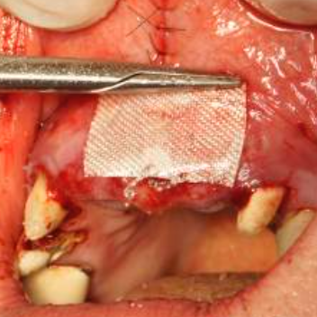 bloodstop, dentingo, bloodstop ix, hämostatikum, matrix, wundheilung, Dental, Dentistry, Zahnarzt, Oralchirurgie, MKG, Extraktion, Sinuslift, Membran, Implantologie, Osteotomie,