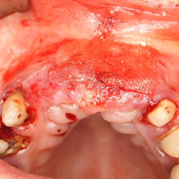 bloodstop, dentingo, bloodstop ix, hämostatikum, matrix, wundheilung, Dental, Dentistry, Zahnarzt, Oralchirurgie, MKG, Extraktion, Sinuslift, Membran, Implantologie, Osteotomie,