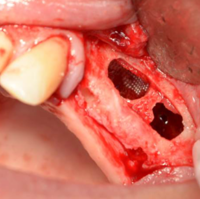 bloodstop, dentingo, bloodstop ix, hämostatikum, matrix, wundheilung, Dental, Dentistry, Zahnarzt, Oralchirurgie, MKG, Extraktion, Sinuslift, Membran, Implantologie, Osteotomie,