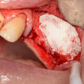 bloodstop, dentingo, bloodstop ix, hämostatikum, matrix, wundheilung, Dental, Dentistry, Zahnarzt, Oralchirurgie, MKG, Extraktion, Sinuslift, Membran, Implantologie, Osteotomie,