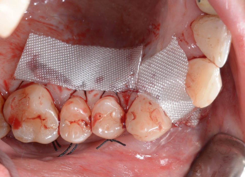 bloodstop, dentingo, bloodstop ix, hämostatikum, matrix, wundheilung, Dental, Dentistry, Zahnarzt, Oralchirurgie, MKG, Extraktion, Sinuslift, Membran, Implantologie, Osteotomie,