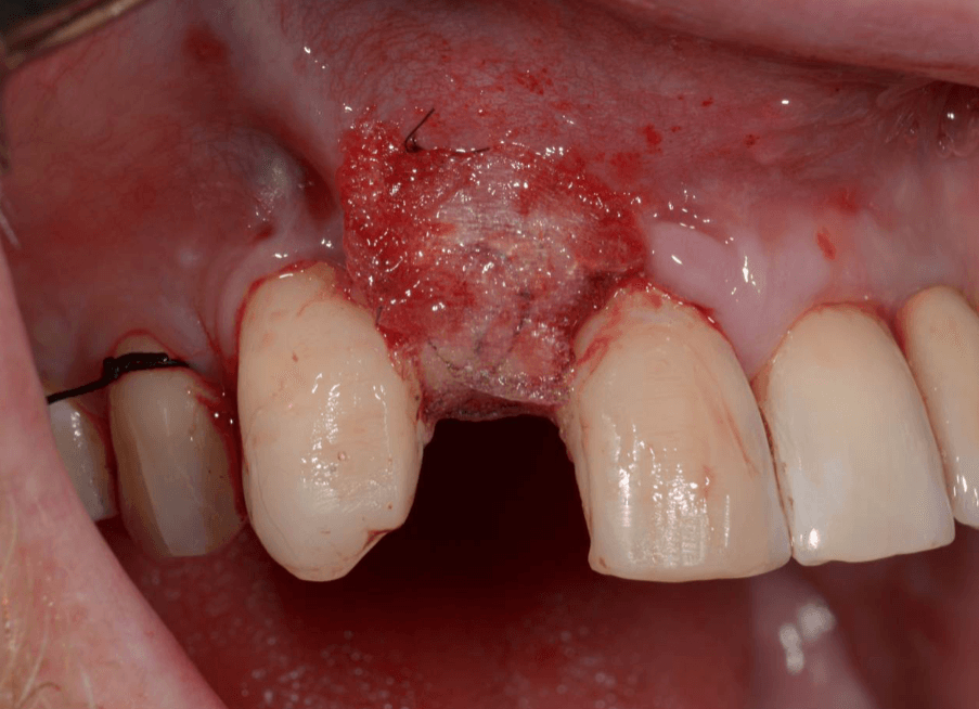 bloodstop, dentingo, bloodstop ix, hämostatikum, matrix, wundheilung, Dental, Dentistry, Zahnarzt, Oralchirurgie, MKG, Extraktion, Sinuslift, Membran,  Implantologie, Osteotomie,