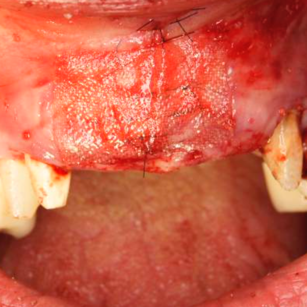 bloodstop, dentingo, bloodstop ix, hämostatikum, matrix, wundheilung, Dental, Dentistry, Zahnarzt, Oralchirurgie, MKG, Extraktion, Sinuslift, Membran, Implantologie, Osteotomie,