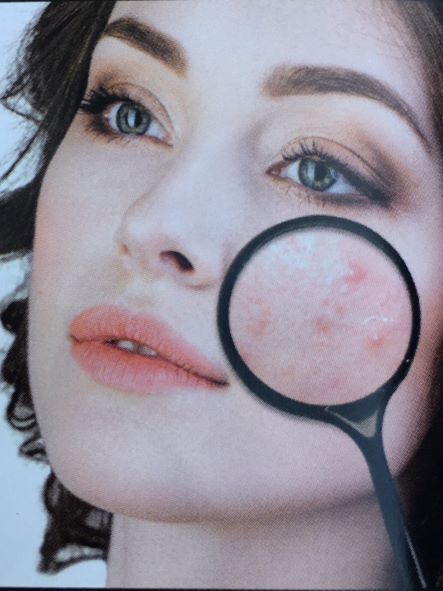 Behandlung unreiner / zu Akne neigender Haut