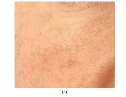 Nach der Behandlung LDM