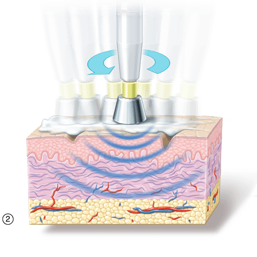 Bild2 zu Radiofrequenz Funktionsweise