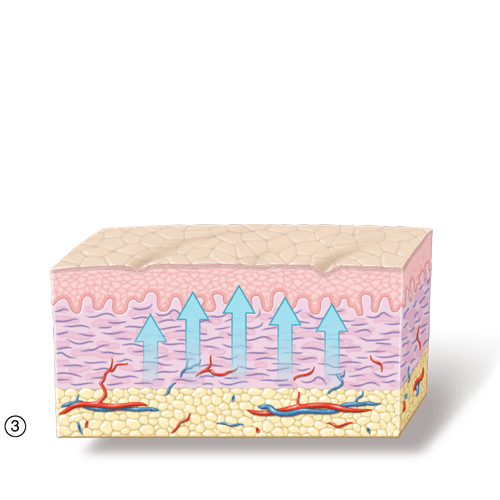 Bild3 zu Radiofrequenz Funktionsweise