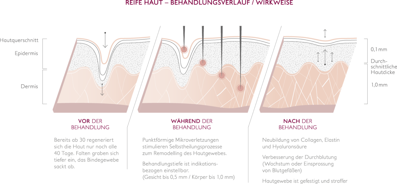 Needling-Technik