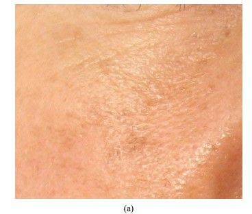 Vor der Behandlung LDM