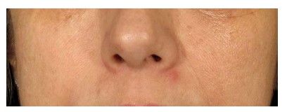 Huautbildverbesserung LDM