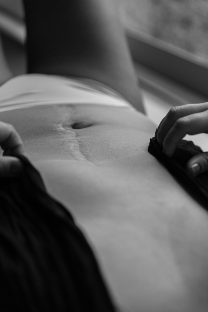 CICATRICES LIMA CLAUDIA QUINTANA DOCUMENTARY PHOTOGRAPHY. FABI COLON CANCER