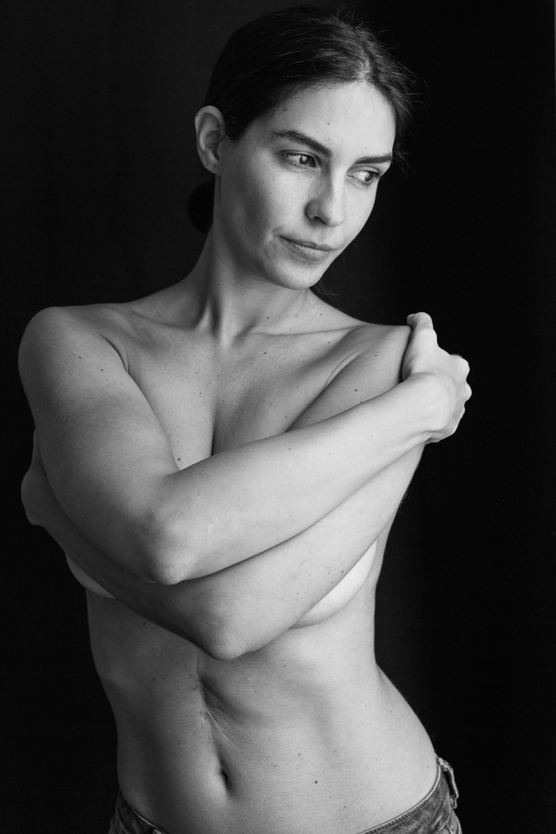 PROYECTO CICATRICES IEFC BARCELONA CLAUDIA QUINTANA FOTOGRAFÍA DOCUMENTAL. YASMINA OPERACIÓN ESTENOSIS PILÓRICA