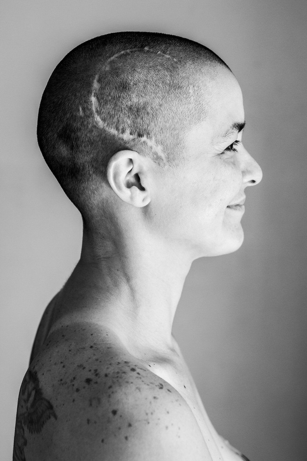 SCARS- CICATRICES LIMA CLAUDIA QUINTANA DOCUMENTARY PHOTOGRAPHY. SANDRA ANEURYSM AND CANCER HODGKIN'S LYMPHOMA