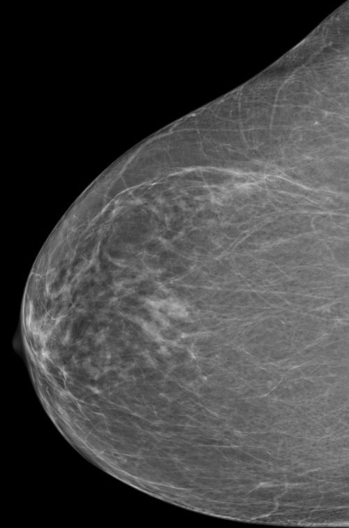 ACR 2 - Beurteilbarkeitsstufe B - fetthaltige Brust mit fibroglandulären Anteilen ACR 2 - Beurteilbarkeitsstufe B - fetthaltige Brust mit fibroglandulären Anteilen