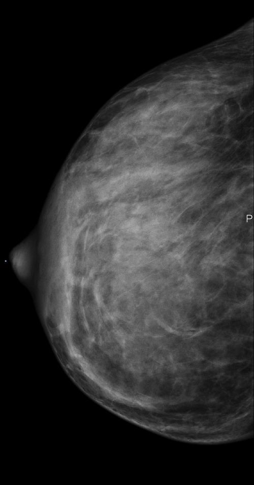 ACR 4 - Beurteilbarkeitsstufe D - sehr dichtes Drüsengewebe ACR 4 - Beurteilbarkeitsstufe D - sehr dichtes Drüsengewebe