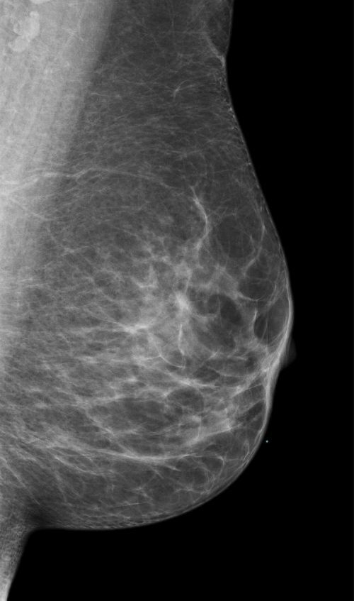 BI-RADS 1 / Befundkategorie 1 - unauffällige Brust BI-RADS 1 / Befundkategorie 1 - unauffällige Brust