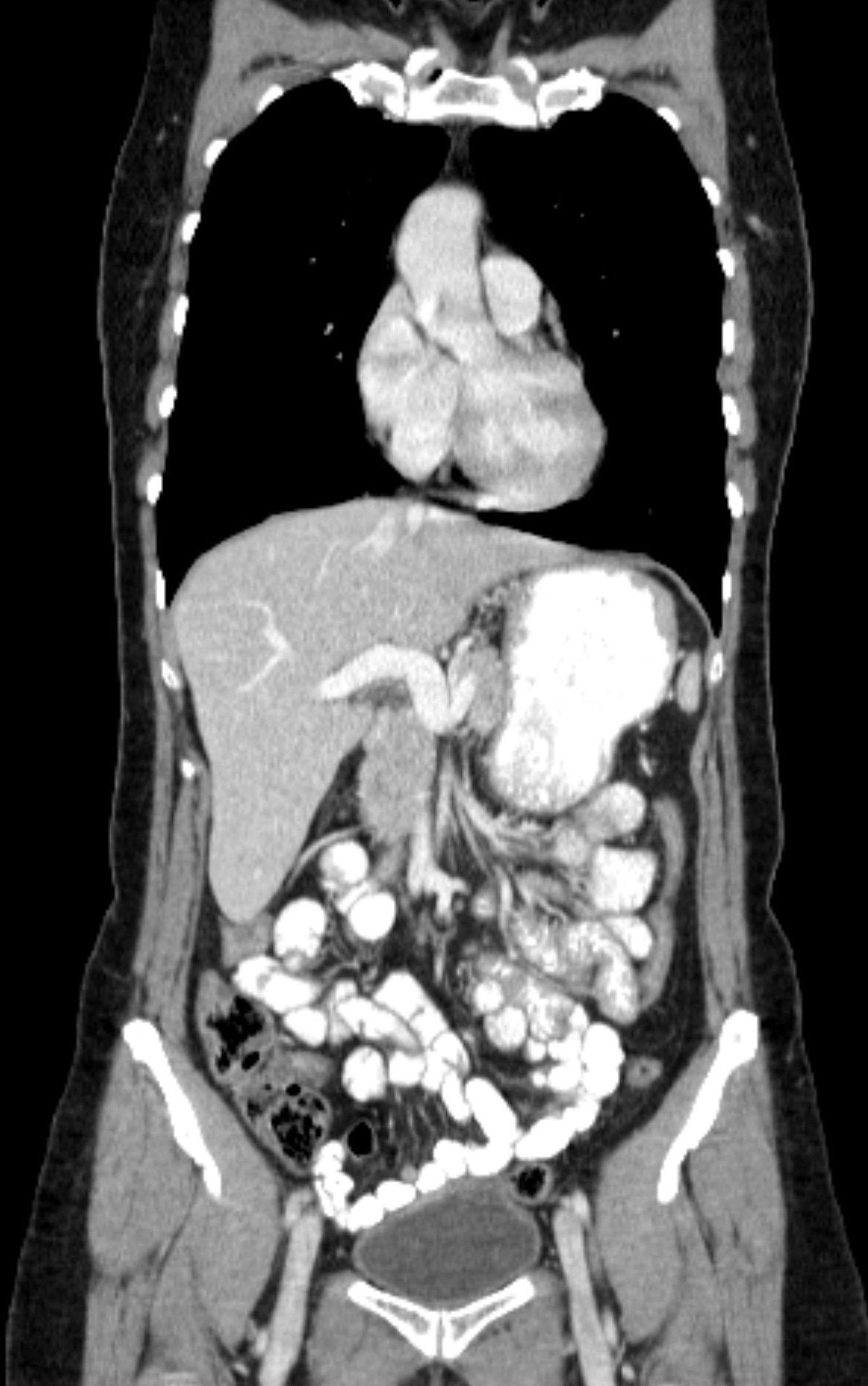 CT von Lunge und Bauch CT Thorax und Abdomen