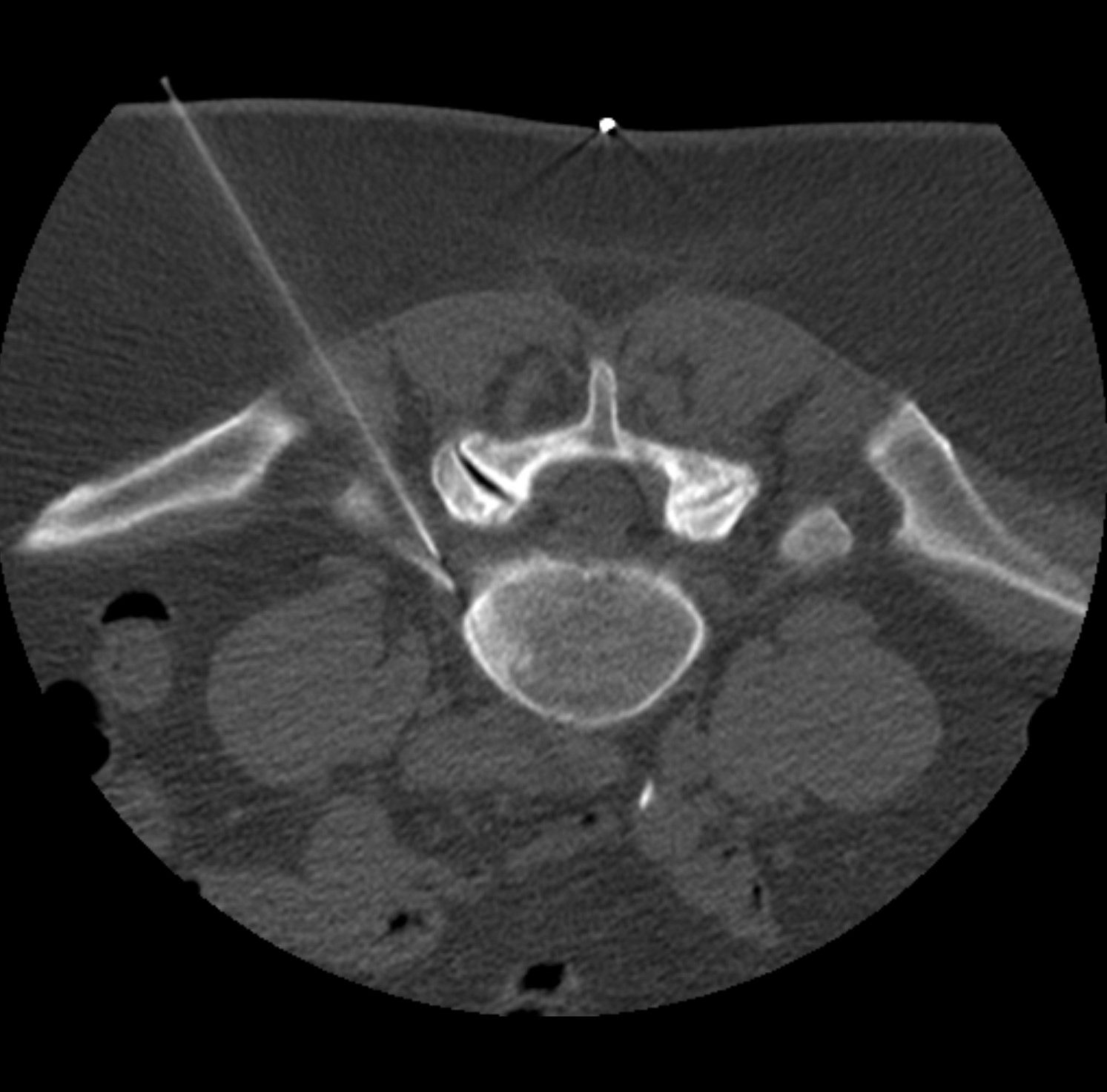 CT gesteuerte Schmerztherapie PRT Darmstadt