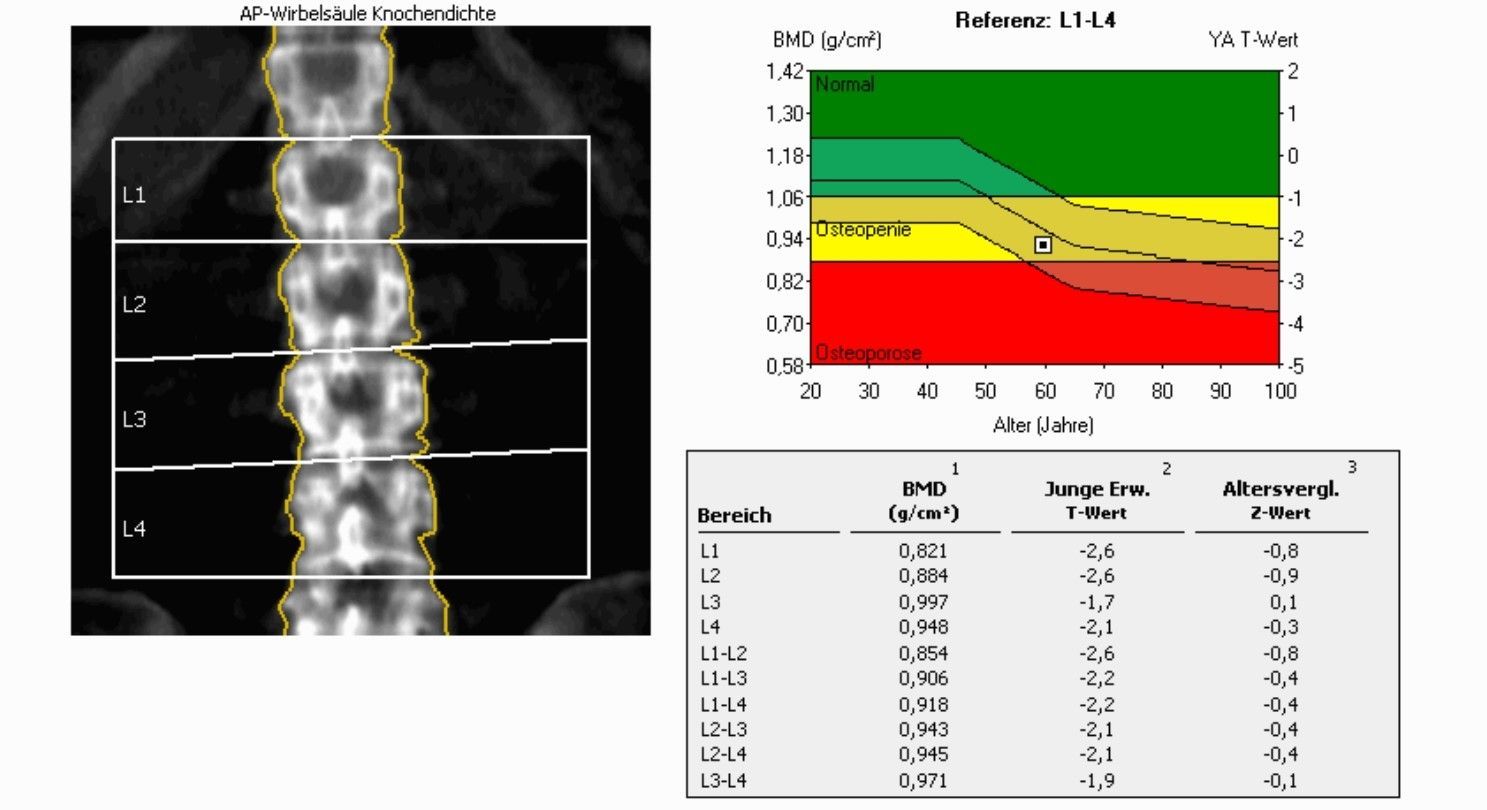 DXA Knochendichtemessung bei Osteopenie an der LWS zur Früherkennung von Osteoporose im Rahmen der Vorsorge DXA Knochendichtemessung bei Osteopenie an der LWS zur Früherkennung von Osteoporose im Rahmen der Vorsorge