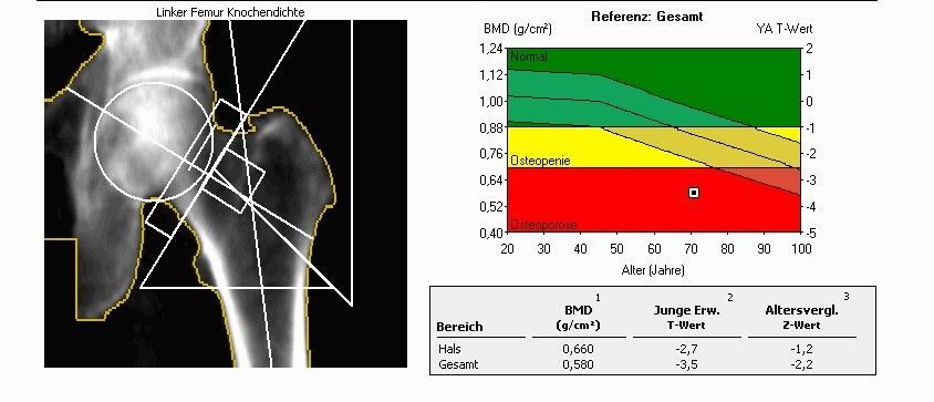 DXA Messung bei Osteoporose DXA Messung bei Osteoporose