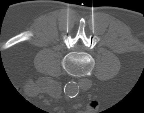 Facettengelenksinfiltration / Facettenblockade an der LWS in Darmstadt Facettengelenksinfiltration / Facettenblockade an der LWS in Darmstadt