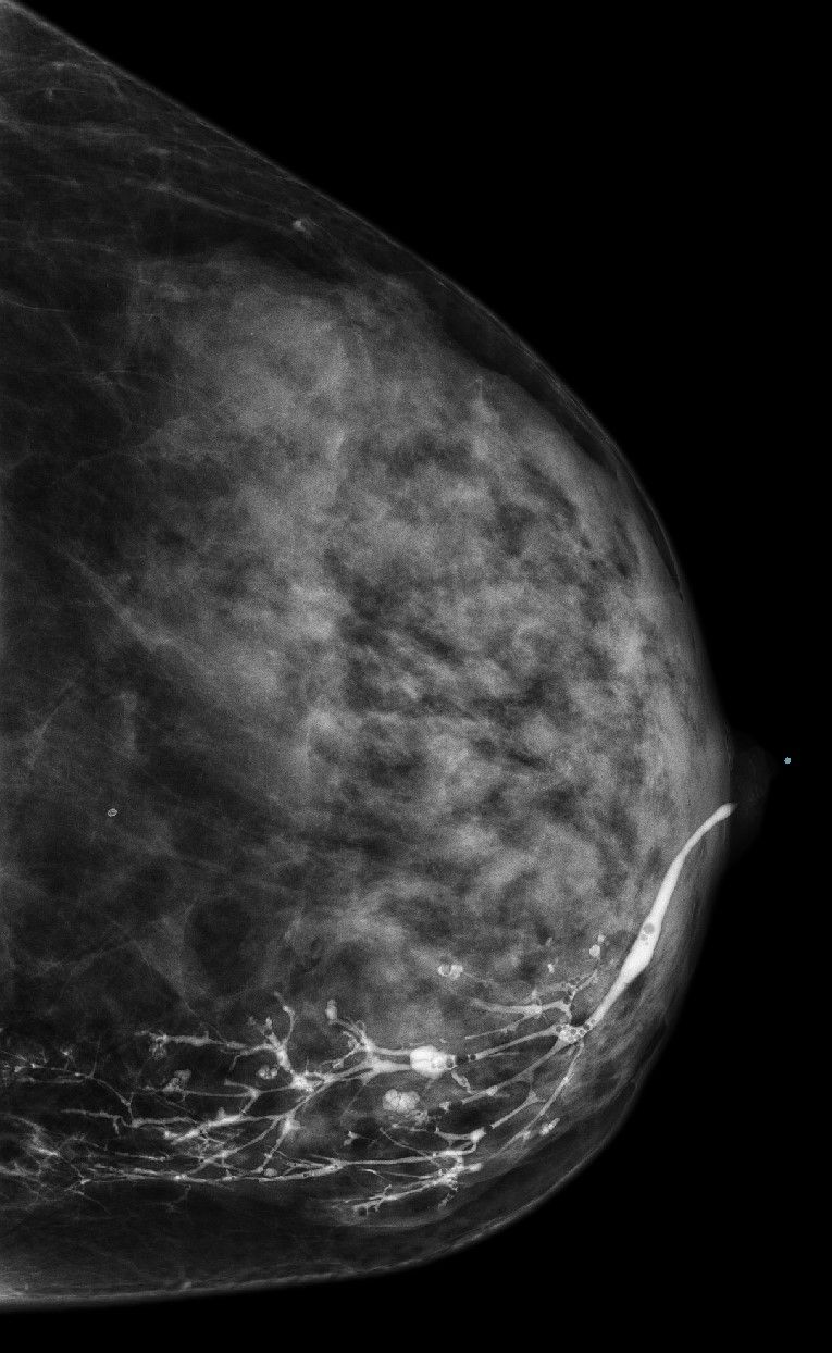Galaktographie Milchgangsdarstellung der Brust Galaktographie Milchgangsdarstellung der Brust
