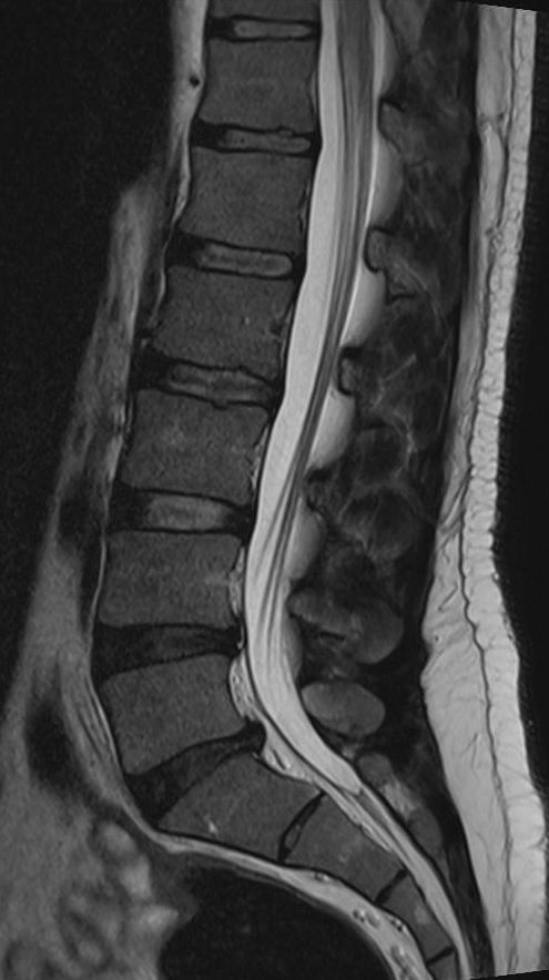 Kernspintomographie (MRT) LWS Kernspintomographie (MRT) LWS