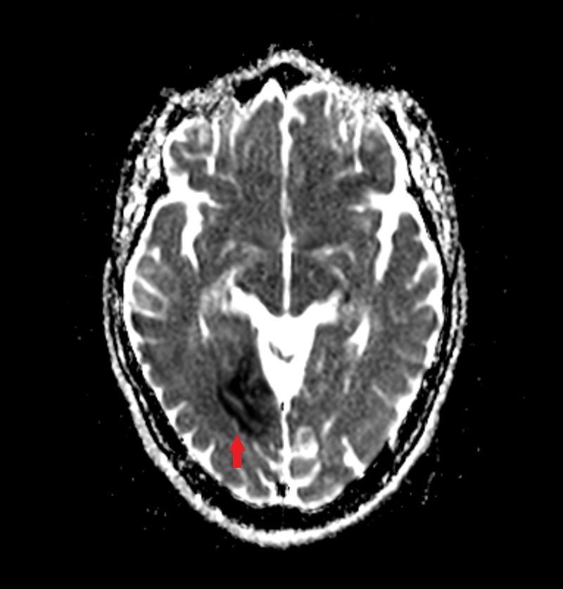 MRT Diffusionswichtung mit Infarkt (Ischämie) rechts ADC-Karte MRT Diffusionswichtung mit Infarkt (Ischämie) rechts ADC-Karte