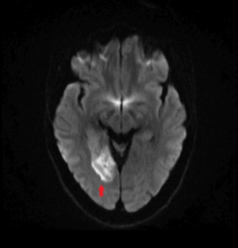 MRT Diffusionswichtung mit Schlaganfall rechts MRT Diffusionswichtung mit Schlaganfall rechts