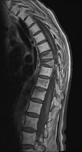 MRT bei alten osteoporotischen Wirbelkörperfrakturen mit Vertebroplastie