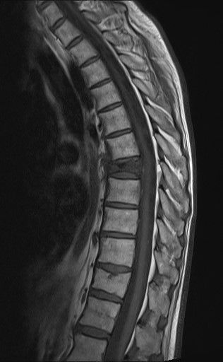 MRT bei frischer osteoporotischer Wirbelkörperfraktur