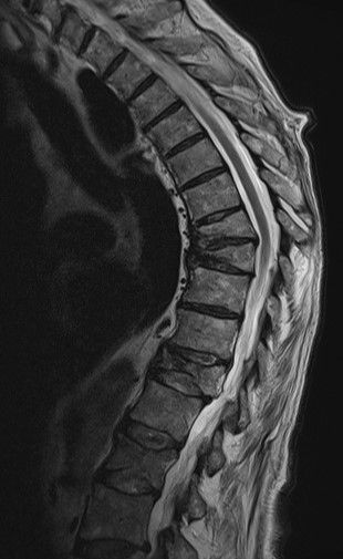 MRT von mehreren osteoporotischen Wirbelkörperfrakturen MRT von mehreren osteoporotischen Wirbelkörperfrakturen