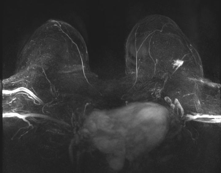 Mamma-MRT im Rahmen der Nachsorge mit neuem Brustkrebs links Mamma-MRT im Rahmen der Nachsorge mit neuem Brustkrebs links