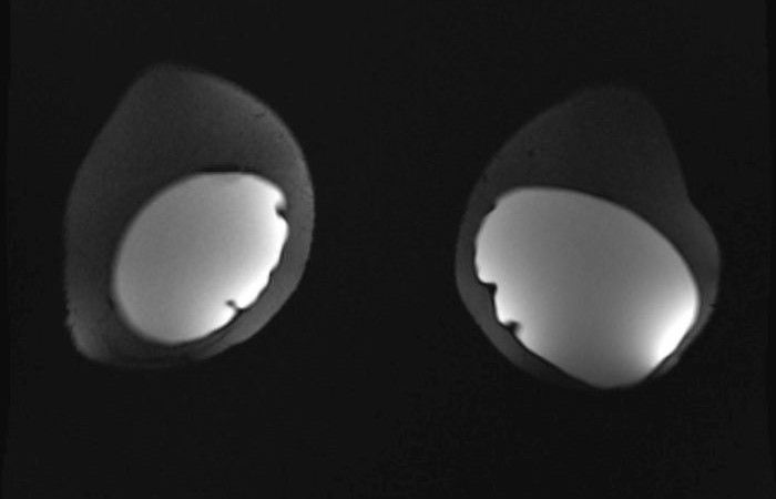 MRT der Mamma bei intakten Silikonprothesen nach kosmetischer Brustvergrößerung MRT der Mamma bei intakten Silikonprothesen nach kosmetischer Brustvergrößerung