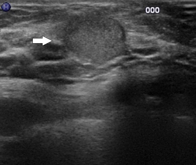 Mammasonographie Fibroadenom Mammasonographie Fibroadenom