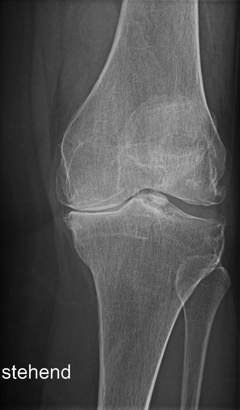 Röntgen Knie mit Arthrose