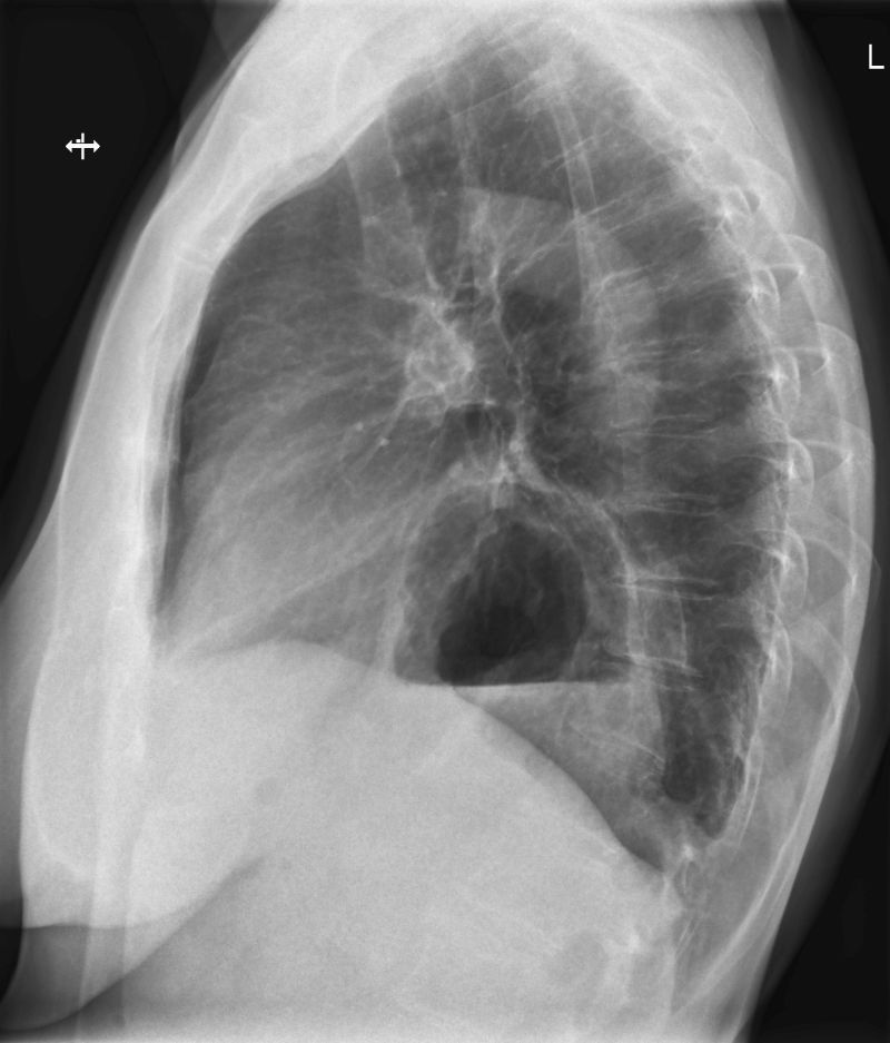 Röntgenbild der Lunge mit Zwerchfellbruch