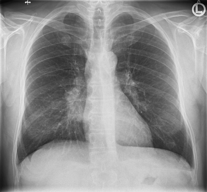 Röntgenbild der Lunge mit Lungentumor