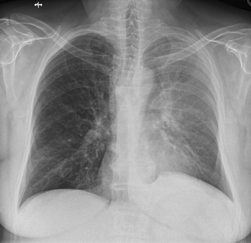 Röntgenbild der Lunge mit Atelektase