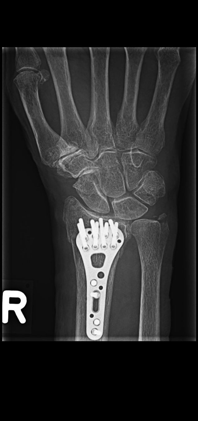 Röntgen Handgegelenk mit Fraktur bei Osteoporose
