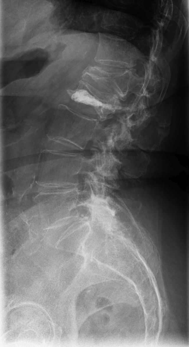 Röntgen von Wirbelkörperfrakturen bei Osteoporose Röntgen von Wirbelkörperfrakturen bei Osteoporose