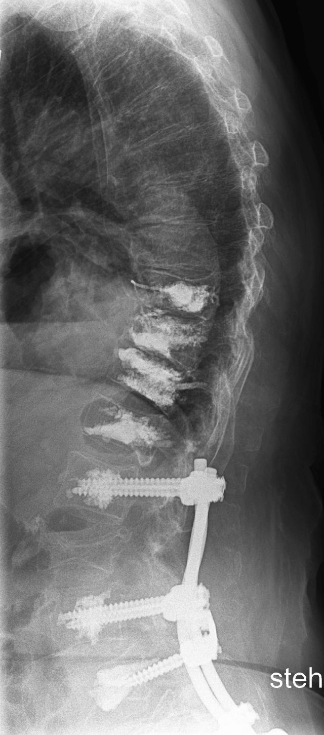 Röntgen eines Abschnitts der Wirbelsäule bei zahlreichen osteoporotischen Knochenbrüchen, behandelt mit Verteborplastie