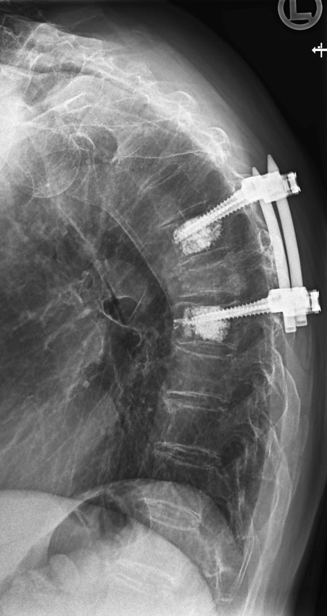 Wirbelkörperbruch bei Osteoporose, behandelt mit zementiertem Fixateur Wirbelkörperbruch bei Osteoporose, behandelt mit zementiertem Fixateur