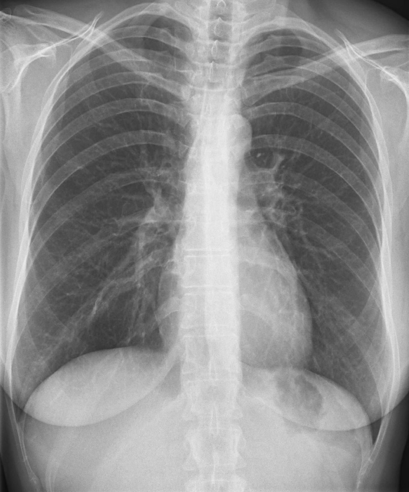 Röntgenbild der Lunge