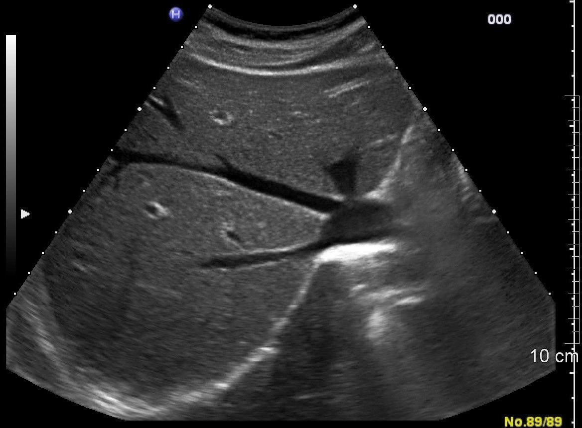 Sonografie der Leber Sonografie der Leber