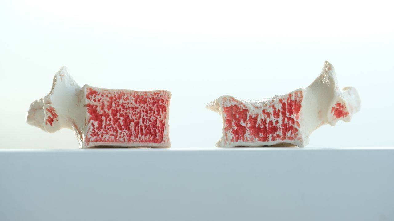 Schnitt durch Wirbelkörper: links normal, rechts mit Osteoporose und Deckplatteneinbruch Schnitt durch Wirbelkörper mit normal Knochenstruktur und mit Osteoporose und Deckplatteneinbruch